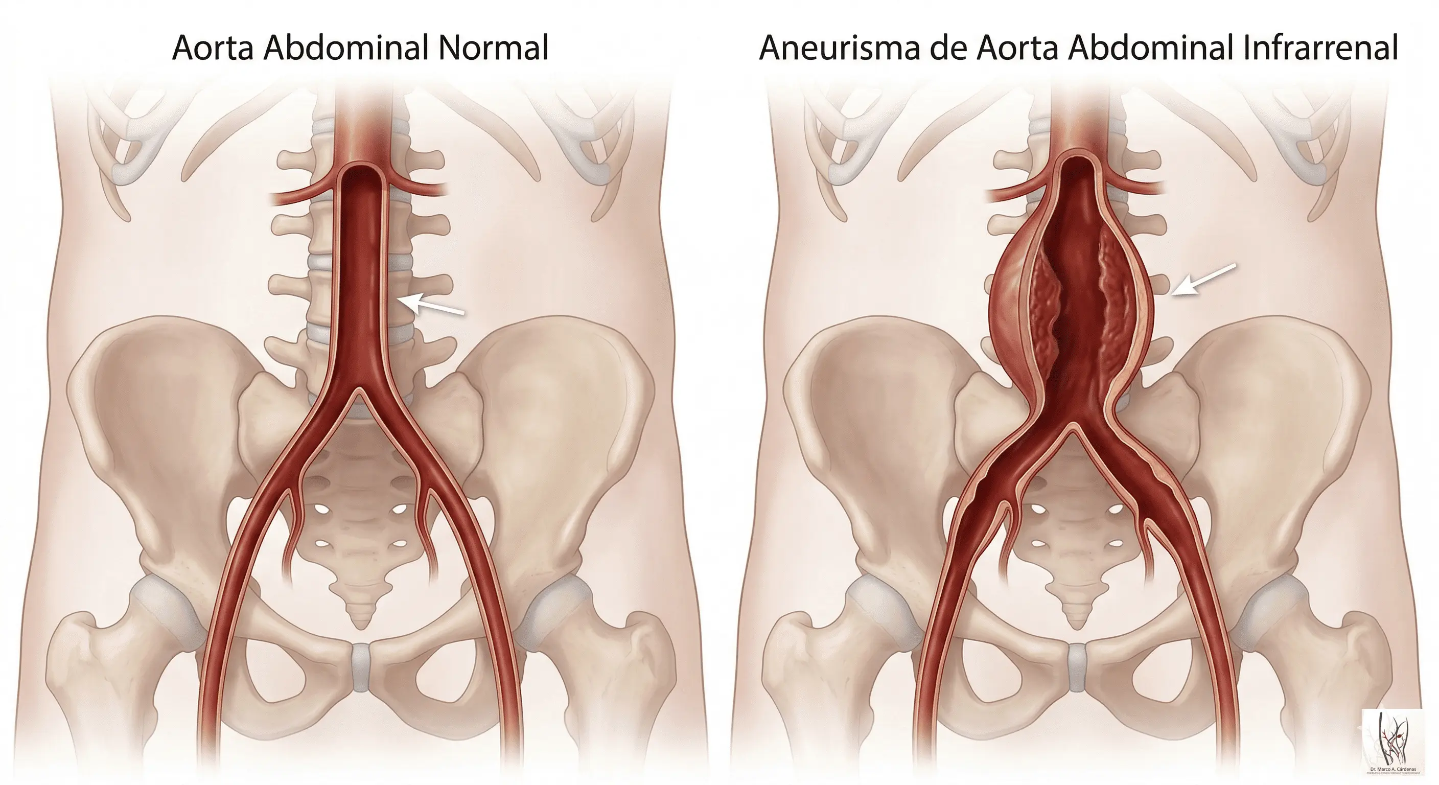 Aneurisma Aorta Abdominal